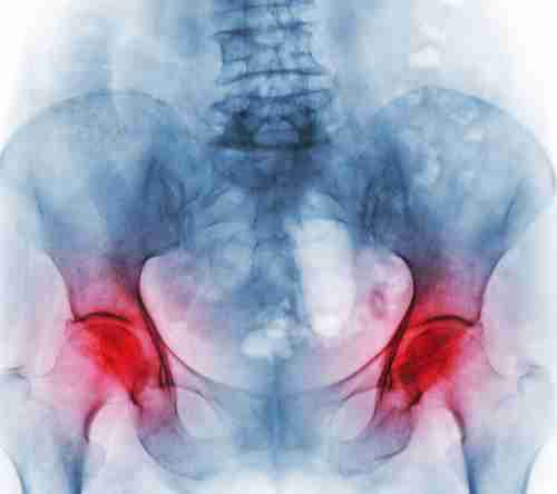 X-ray of damaged hip in need of hip replacement surgery