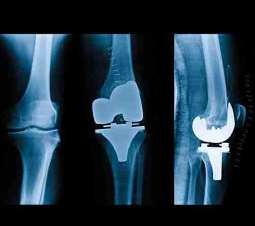 Revision Joint Surgery